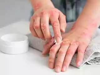 Psoriasis Treatment