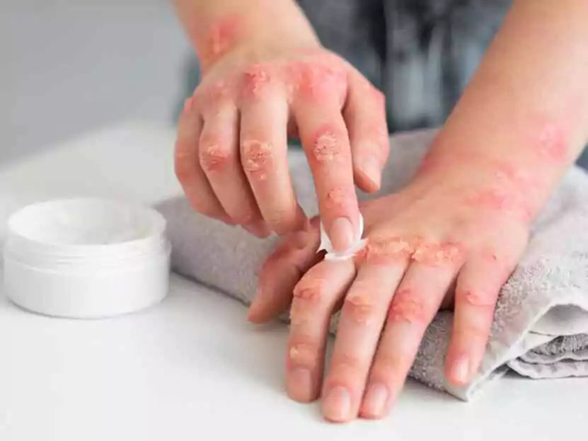 Psoriasis Treatment